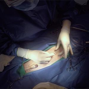 thumbnail - extrohepatic portosystemic liver shunt surery