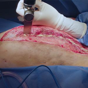 thumbnail - porcupine quills in the chest cavity