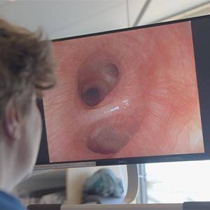 thumbnail - bronchoscopy and bronchoalveolar lavage